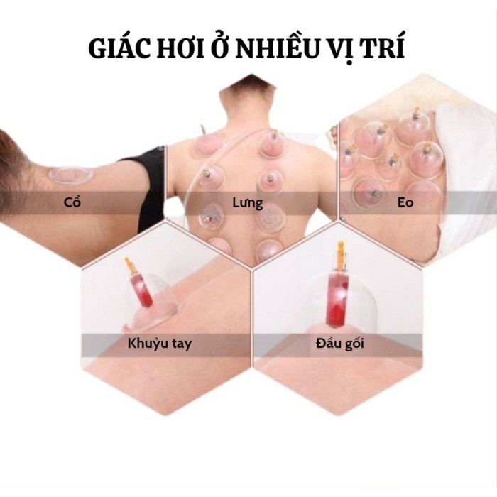 Bộ giác hơi không dùng lửa 24 phụ kiện KAW, Giảm đau nhức, Tăng cường tuần hoàn máu